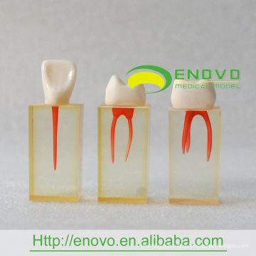 EN-N5 Enlarge Root Canal Transparent Block with Colored Pulpal Wall and Crowns